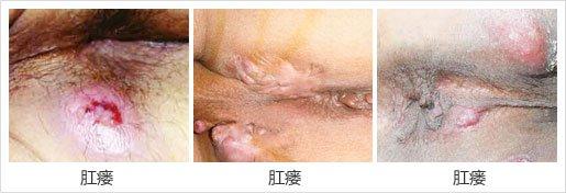 肛瘺圖.jpg