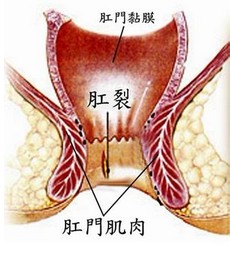 肛裂.jpg
