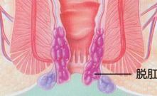 脫肛.jpg