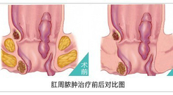 肛周膿腫手術(shù)前后.jpg